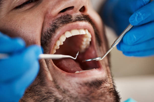 Best Emergency Dental Care for Broken or Chipped Teeth in Manistique, MI